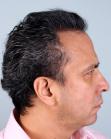 After Hair Transplant&nbsp;Front